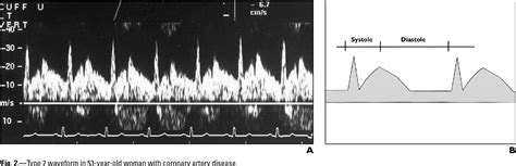 Figure From Vertebral Artery Doppler Waveform Changes Indicating