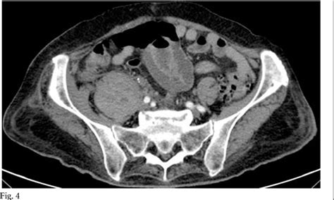 Figure 4 From Iliopsoas Hematoma After Total Hip Arthroplasty Using A