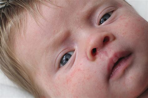 Eczema (dermatitis) one of the common reasons for a rash on the chest is contact dermatitis which may refer to skin inflammation or an adverse reaction to something that touches the skin. 5 Common Baby Skin Allergies And Its Causes