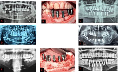 Significant Vertical Ridge Augmentation Allowing Implant Placement