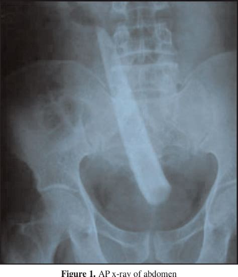 Figure 1 From Rectal Impaction Of A Foreign Object Semantic Scholar
