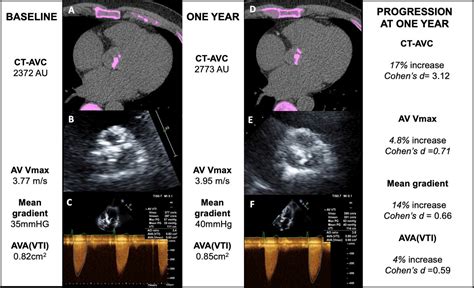 Computed Tomography Aortic Valve Calcium Scoring For The Assessment Of Aortic Stenosis