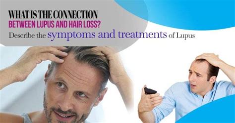 What Is The Connection Between Lupus And Hair Loss Describe The