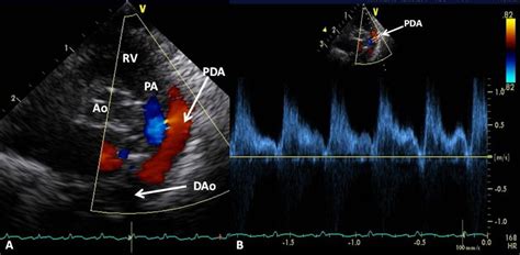 Parasternal Short Axis Echo Doppler Imaging A Demonstrating Patent