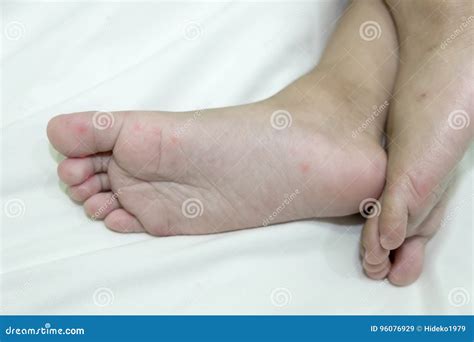 Allergic Rash Skin Of Baby`s Right Foot Stock Image Image Of Eczema