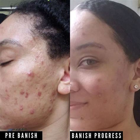 Pumpkin Enzyme Masque Natural Acne Clearing Mask Banish