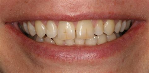 Today, in this article we will try to show how life turned after internet and what it used to before internet. Dental Veneers Before and After - Preventive Dentistry ...