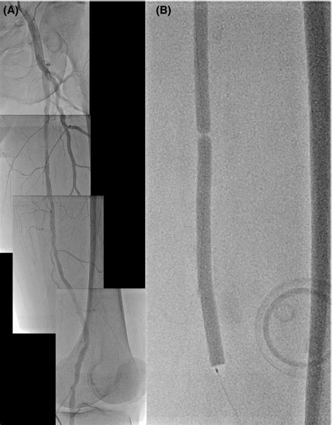 A Angiogram Showed Multiple Stenosis From The Proximal Superficial