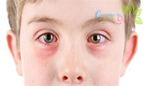 11 Remedios Caseros Para La Infección En Los Ojos Vida Y Salud