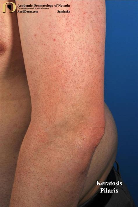 Keratosis Pilaris In Adults Condition Treatments And Pictures My Xxx