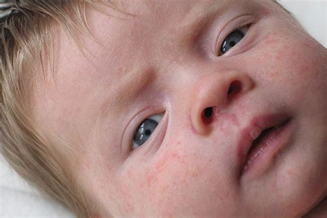 5 Most Common Baby Skin Allergy Symptoms And Its Causes Baby Food