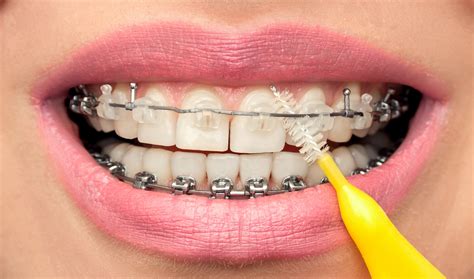 ¿cómo Realizar Una Correcta Higiene Dental Con Brackets Grupo Dental