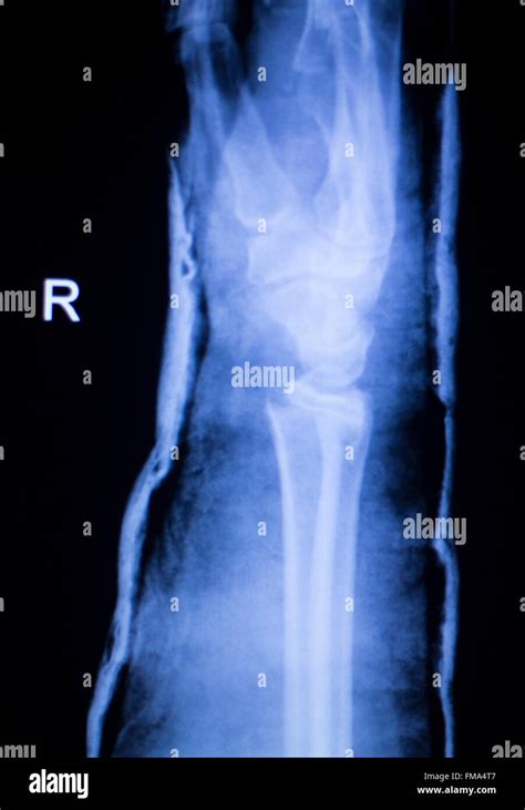 Forearm Arm And Elbow Injury Xray Scan Test Reults To Diagnose Pain