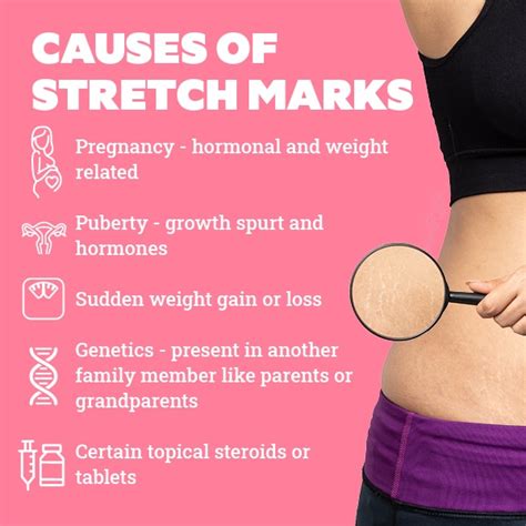 how to deal with stretch marks in teenagers be beautiful india