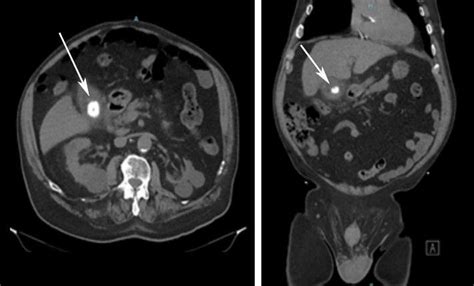 Axial And Coronal Views Of The Pre Operative Ct Scan Demonstrating A
