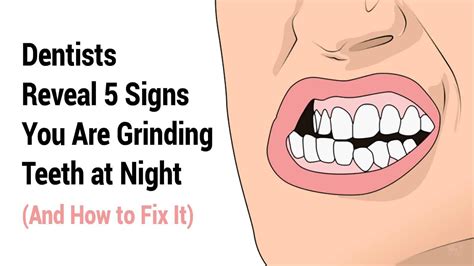 Dentists Reveal 5 Signs You Are Grinding Teeth At Night And How To Fix It In 2021 Grinding