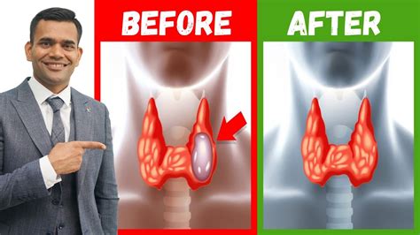How To Shrink Thyroid Nodules Naturally Effective Natural Treatment