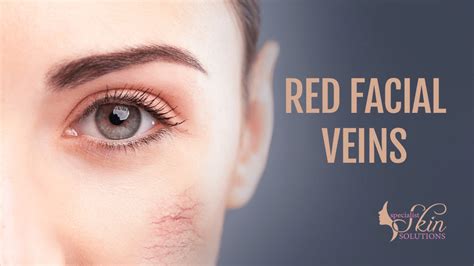 How You Can Get Rid Of Facial Spider Veins Telangiectasias