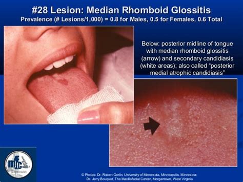 Common Oral Lesions