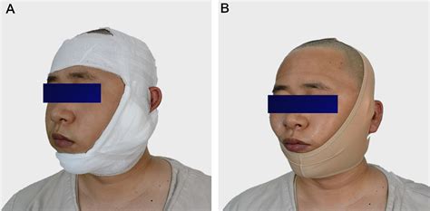 Predictors Of Sialocele Or Salivary Fistula After Partial Superficial