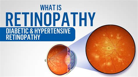 What Is Retinopathy Diabetic Retinopathy Hypertensive Retinopathy Youtube