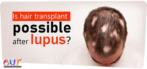 Is Hair Transplant Possible After Lupus But Mag