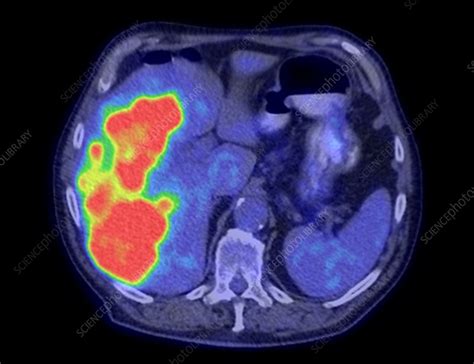 Secondary Liver Cancer Ct And Pet Scan Stock Image C0390159