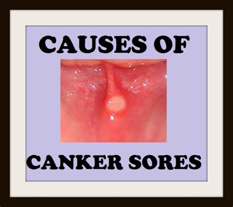 Common Causes Of Canker Sores Healdove