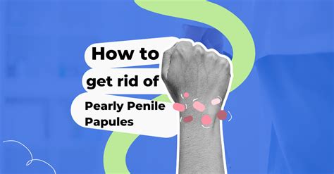 How To Get Rid Of Pearly Penile Papules
