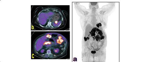 3d Mip A And Axial Fused Petct Images B And C For A 70 Year Old