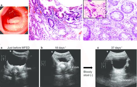 Endoscopic Ndings Suggestive Of Colonic Ischaemia A Haemorrhagic My XXX Hot Girl