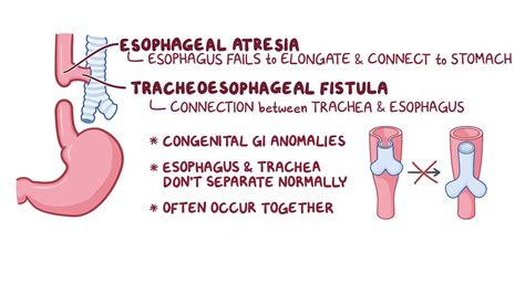 Esophageal Atresia Tracheoesophageal Fistula Nursing Osmosis Video