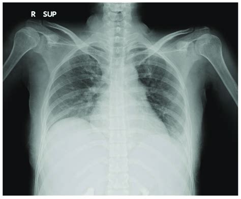 Chest X Ray Showing Moderate Left Pleural Effusion Download Sexiezpicz Web Porn