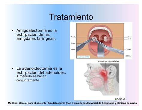 55129434 Amigdalitis Herpangina