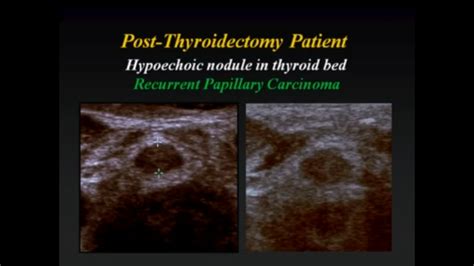 Cervical Lymph Nodes Thyroidectomy Lymph Nodes Ultrasound