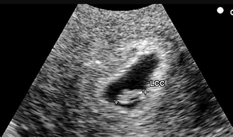6 Week Ultrasound Pictures Twins And All You Need To Know