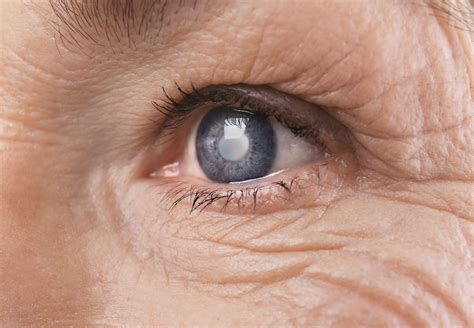 How To Prevent Glaucoma Cataracts And Macular Degeneration