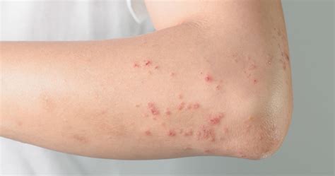Itchy Rash And Bumps On Elbows Images And Photos Finder