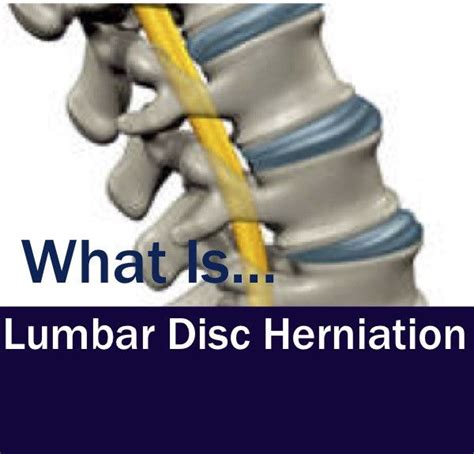 Explanation Of A Herniated Lumbar Disc Including Causes Symptoms And