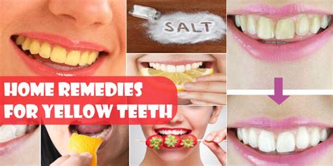 Can i minimize the gap between my two front teeth without braces? How To Get Rid Of Yellow Teeth By Using 4 Home Remedies ...
