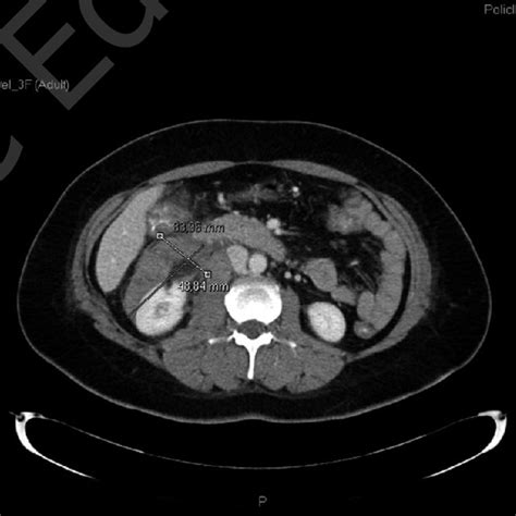 Ct Scan Of The Abdomen Axial Section Showing A Retroperitoneal