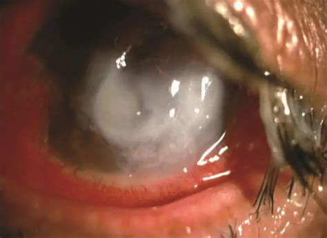 Microbial Keratitis American Academy Of Ophthalmology