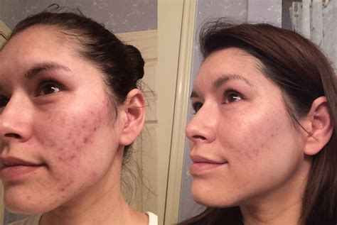 8 Incredible Acne Transformations Before And After Pictures The Korean