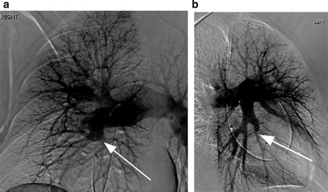 A Digital Subtraction Angiography Of Right Pulmonary Circulation