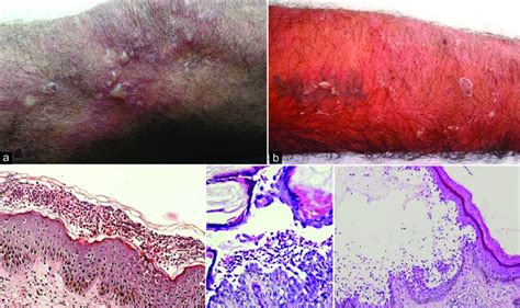 Clinical Appearance Of Skin Lesions On The Left Leg Showing Grouped