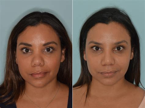 Rhinoplasty Photos Dr Anthony Bared Md Facial Plastic Surgeon