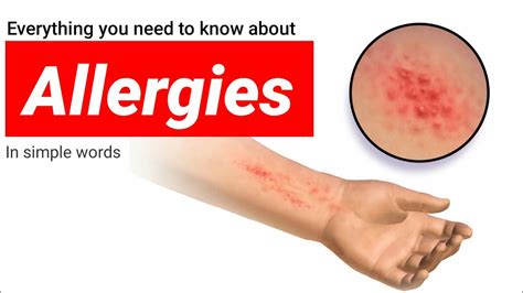 What is allergy. An introduction to allergy. How to treat allergy at