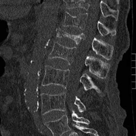 Sagittal Reformatted Ct Of The Lumbar Spine In An 83 Year Old Female