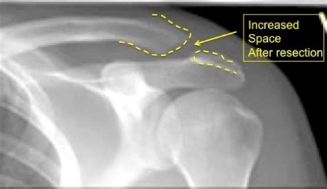 Ac Joint Injuries Boston Shoulder Institute