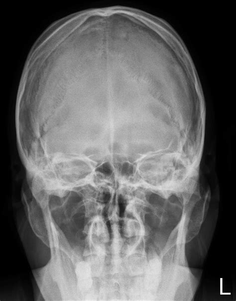 Skull X Ray Anterior Posterior View Showing No Abnormal